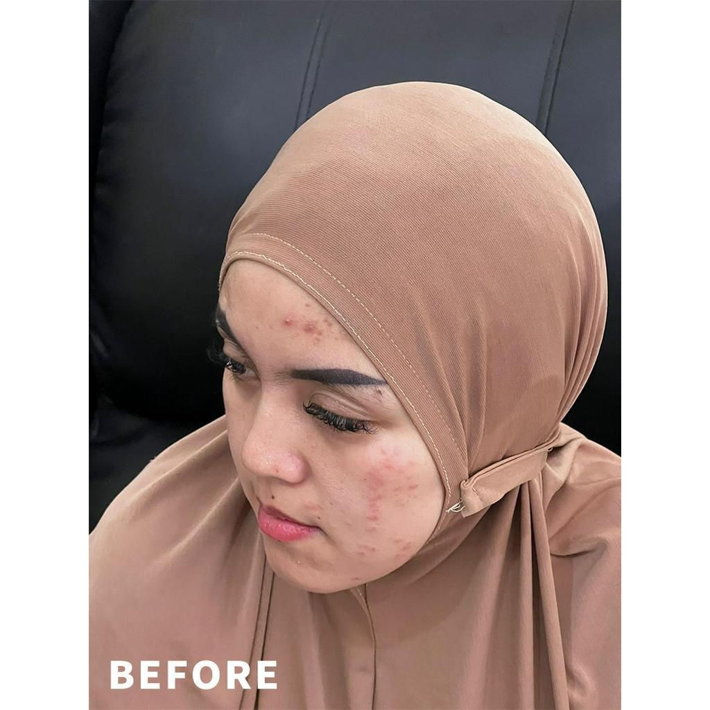 Kanemochi Beauty - ACNE COMPLETE (Isi 4 pcs). Skin... - Gambar 3